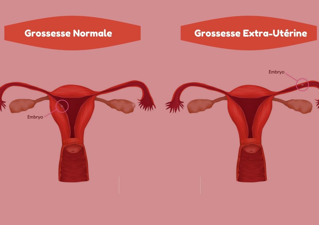 Tout sur la grossesse extrautérine ou ectopique O